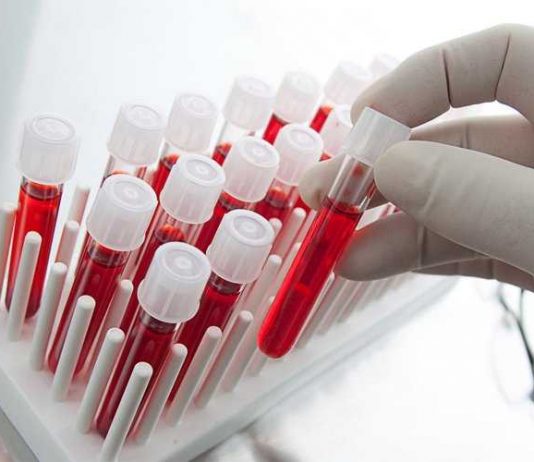 Svjetski dan borbe protiv AIDS: U ponedjeljak anonimno testiranje na viruse HIV i hepatitis